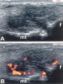 Artrite cronica giovanile e imaging: tecniche a confronto 65 Risonanza magnetica del piede destro (effettuata dopo sei mesi dall esordio clinico): quadro sostanzialmente invariato rispetto all esame