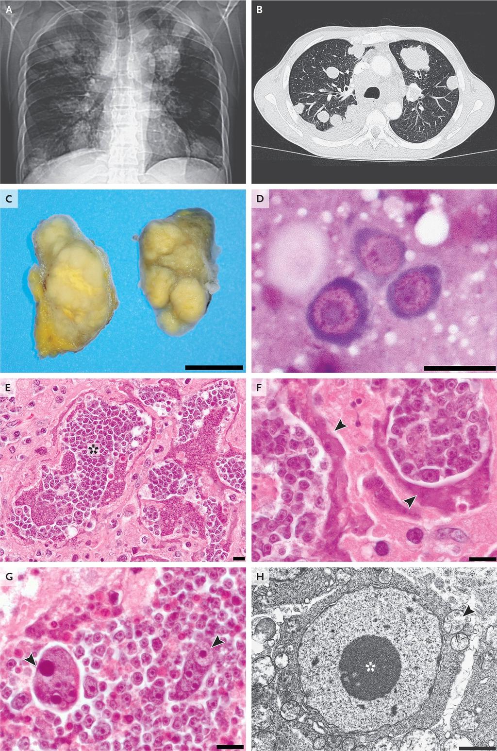 Radiographic and Pathological Features of Malignant