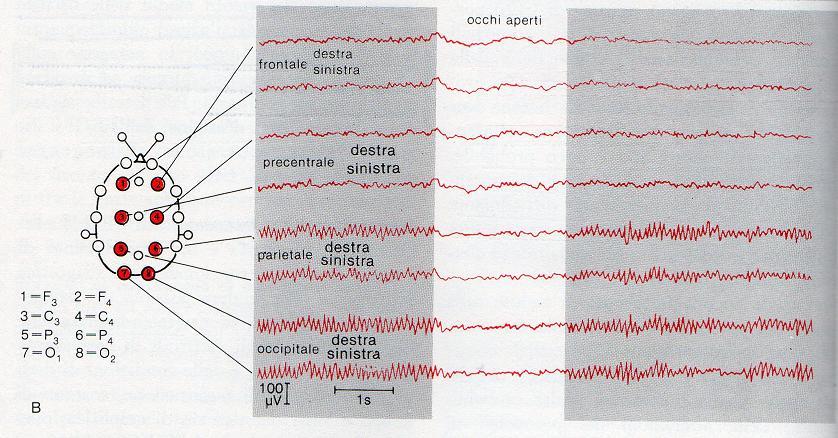 EEG Elettroencefalogramma Registrazioni dell attività elettrica cerebrale Hans Berger (1929) Tipo di registrazione: bipolare vs.