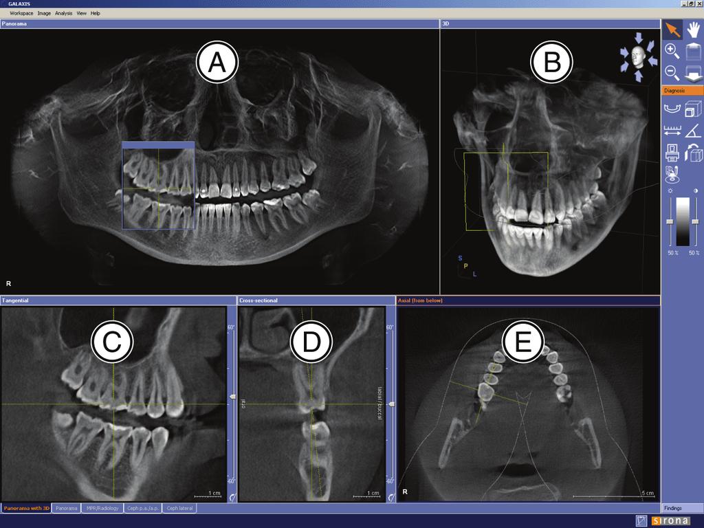 Sirona Dental Systems GmbH 6 Aree di lavoro Area di lavoro "MPR/Radiologia" Viste A Vista panoramica [ 22] B