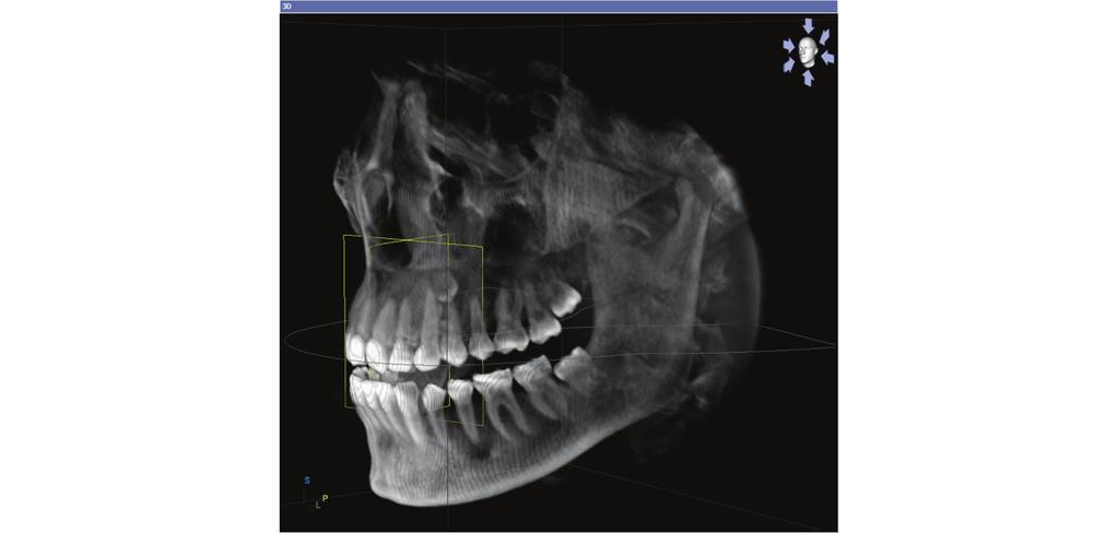 7 Viste Sirona Dental Systems GmbH Vista longitudinale Panorama con 3D 7.2.1 Vista 3D nelle aree di lavoro MPR/Radiologia 7.2.2 Interazione Rotazione della vista 3D 1.