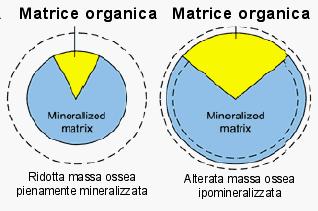 Età di esordio Postmenopausa Adulti o bambini Meccanismo Perdita ossea Ridotta mineralizzazione Cause Carenza di ormoni sessuali Terapia steroidea Deficienza di calcio o Vitamina