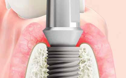 TECNICA DI FRESAGGIO WIDE ADATTA PER L UTILIZZO IN UN SITO DI ESTRAZIONE PREMOLARE E MOLARE Il sistema di impianti Wide è stato progettato per adattarsi perfettamente alla forma naturale del sito di