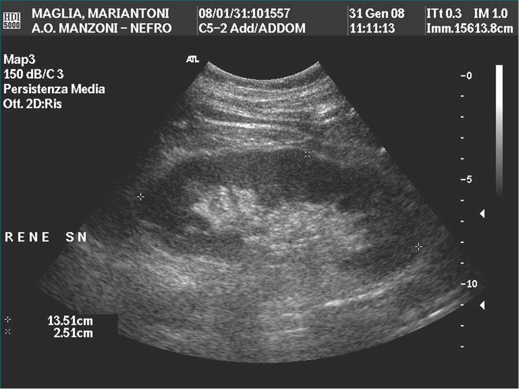 IRC da cause multiple M, 73 aa, Cr 2.