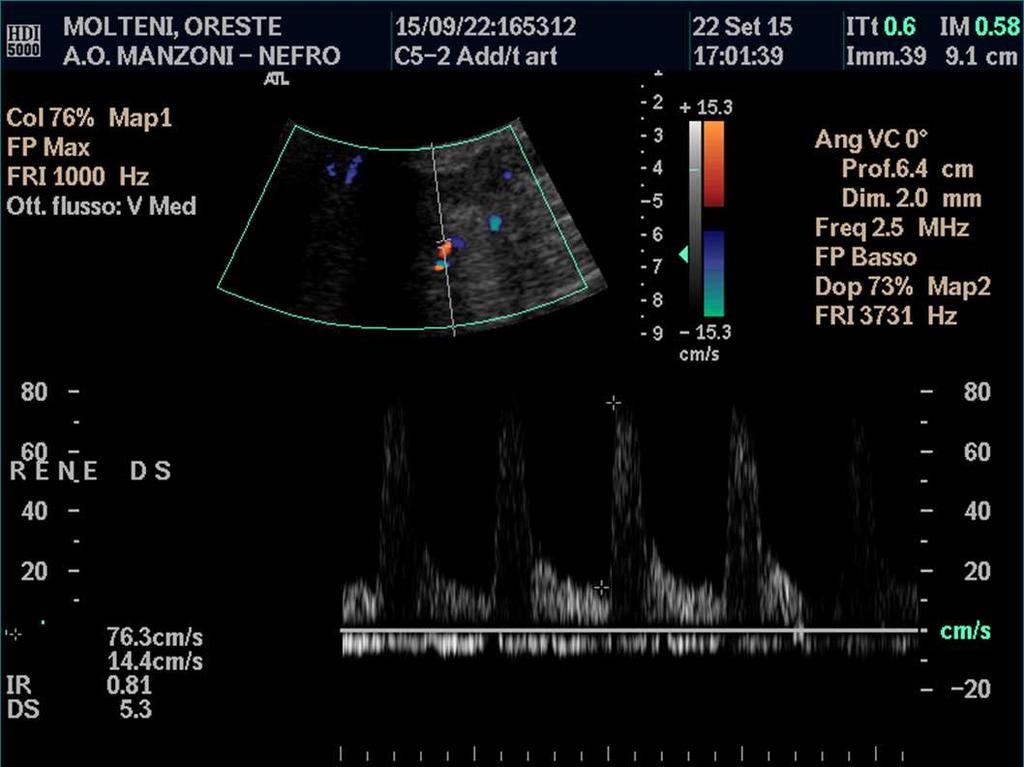 prostatica, ectasia aorta