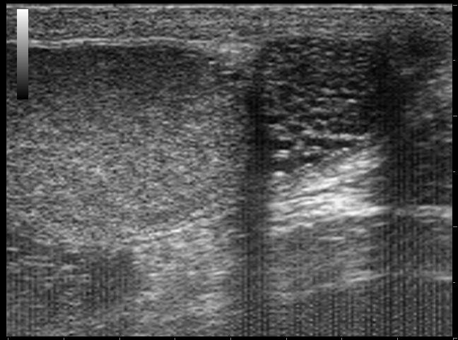 Fig. 1: Artefatti elettromagnetici ambientali: effetto pioggia da elettrobisturi.