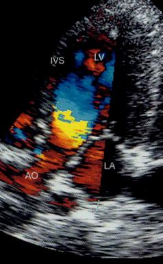 Fig. 17: COLOR DOPPLER: il colore rosso indica che il flusso si sta avvicinando verso la sonda, il colore blu