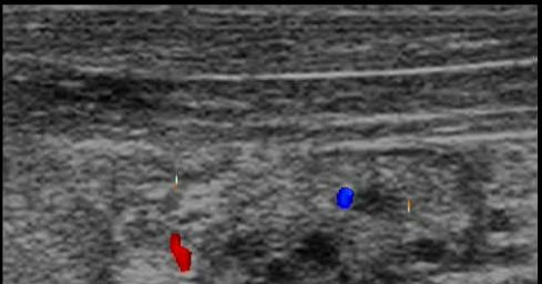 Fig. 22. Ovaio sinistro, secondo giorno del proestro. I follicoli appaiono come piccole ed irregolari aree anecogene nel parenchima ovarico Fig. 23.