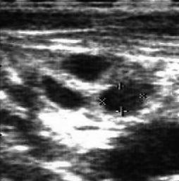 Fig. 24: ovaio destro, secondo giorno dell estro. I follicoli deformano l ovaio.
