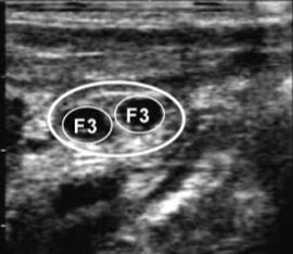 Fig. 28: immagine ecografica di un ovaio che