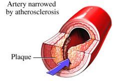 Diabete di tipo I - alterazione del metabolismo lipidico: conseguenze Lipoproteina lipasi (membrana delle cellule endoteliali): l espressione e attività sono stimolate dall insulina In assenza di