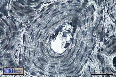 TESSUTO OSSEO L osseina viene depositata in strati, formando strutture cilindriche dette osteoni, costituite da lamelle