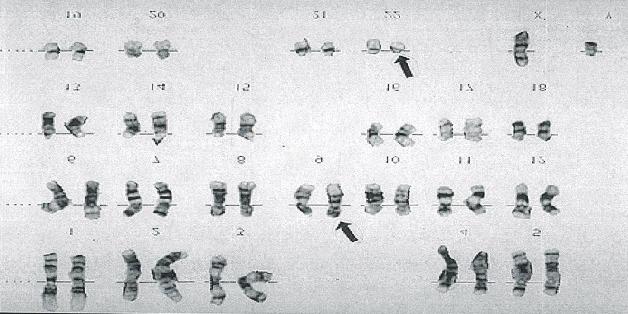 22 Cromosoma Philadelphia 1960