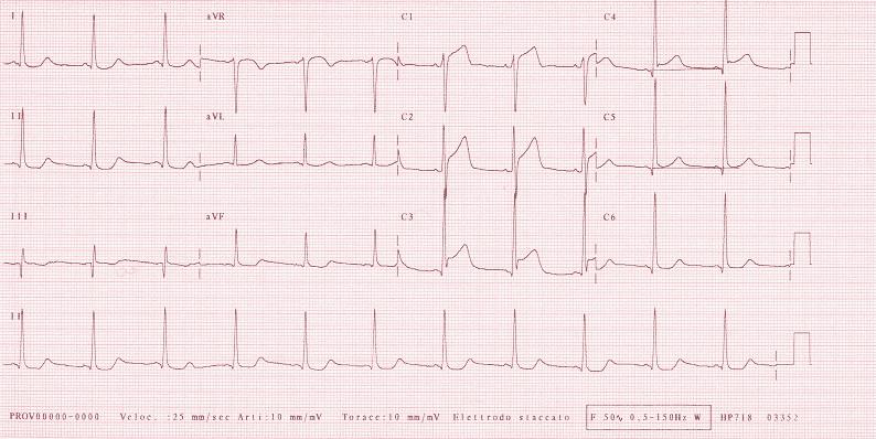 Tracciato elettrocardiografico diagnostico maschio, 55