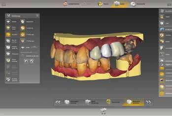 * I dati ottici vengono associati ai dati radiografici 3D (Orthophos SL 3D, XG 3D o Galileos) per la successiva pianificazione implantare ed esportazione come file di