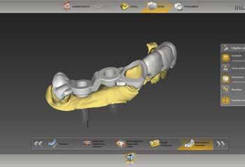 , inlab MC X5 (ossido di zirconio o PMMA), i ponti e le barre avvitati direttamente su abutment Multi-Unit di nt-trading e Medentika vengono progettati con il software CAD