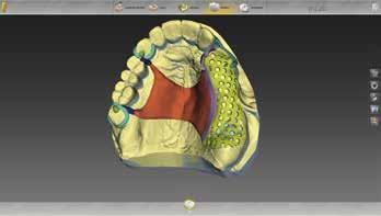 del blocco occlusale e successivamente trasferirla al plug-in inlab Splint del software.