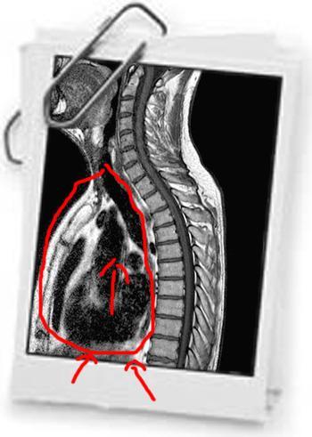 Strutture artefattanti Tutte le strutture anteriori al rachide possono generare artefatti. Aorta, cuore. Dopo mdc gli artefatti vengono amplificati.