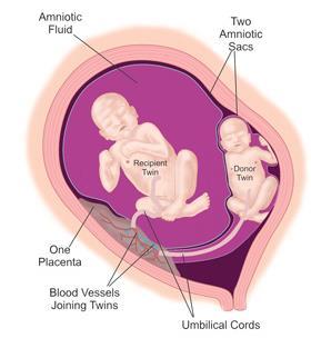 L oligoidramnios può essere talmente severo da non permettere la visione delle membrane amniotiche, essendo esse adese al feto, portando al cosiddetto quadro ultrasonografico di Stuck twin.