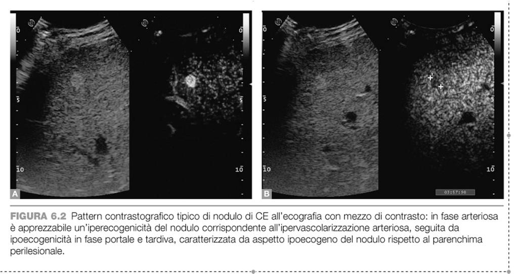 PATTERN OF VASCOLARIZZAZIONE FASE ARTERIOSA: NODULO E PIU VASCOLARIZZATO DEL PARENCHIMA EPATICO FASE