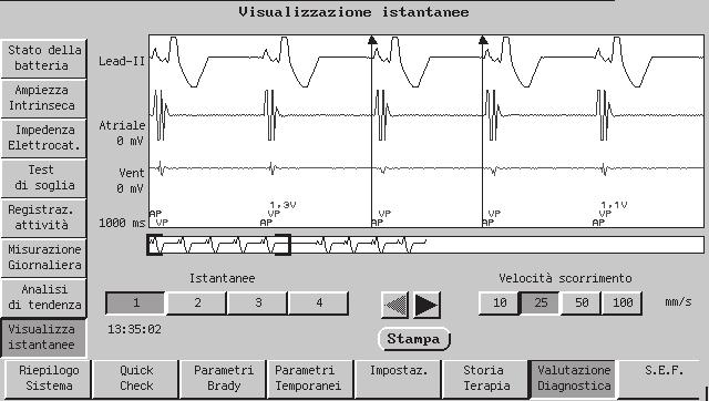 7-36 DIAGNOSTICA E FOLLOW-UP VALUTAZIONE DIAGNOSTICA Passando al livello di risoluzione superiore, è possibile posizionare il calibro in un singolo ciclo trascinandolo con la penna o selezionando i