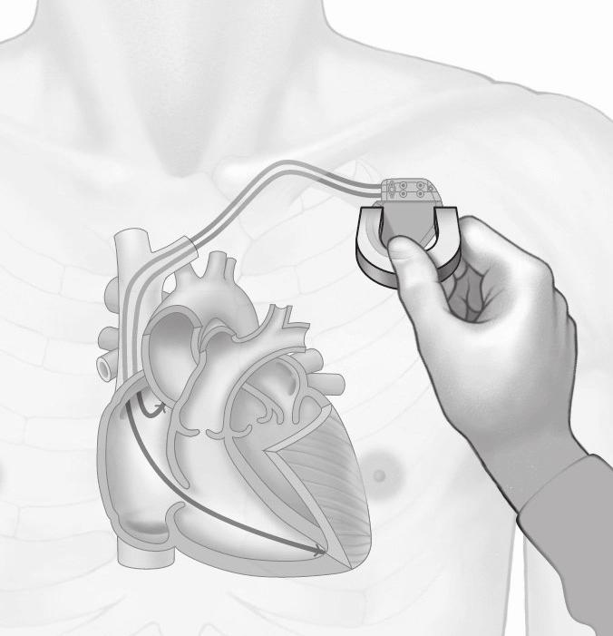INFORMAZIONI POST-IMPIANTO FUNZIONAMENTO DEL DISPOSITIVO AL RAGGIUNGIMENTO DELLA DATA DI SOSTITUZIONE CONSIGLIATA (ERT) 4-5 Il pacemaker resta nella modalità di risposta al magnete per il tempo in