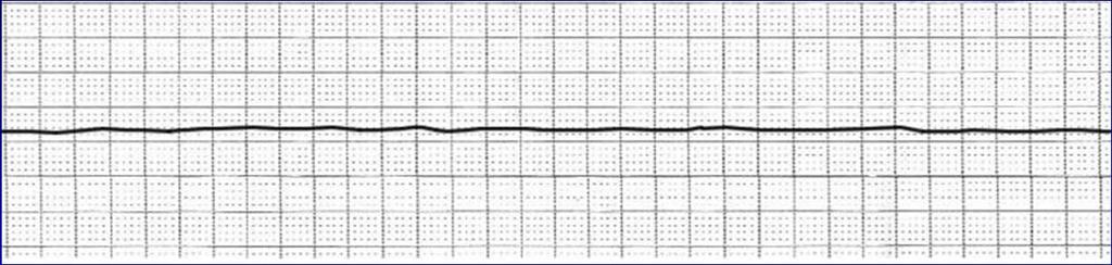 Interferenze con la funzionalità del pacemaker Nel contesto del campo magnetico statico di elevata intensità di uno scanner moderno, il comportamento dell interruttore ad induzione magnetica (reed