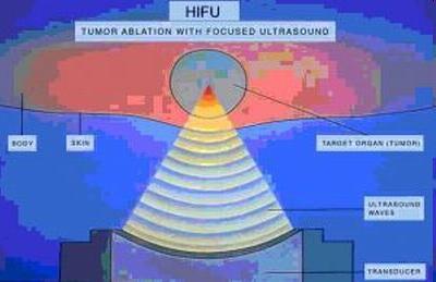 Ultrasound c è ancora parecchio