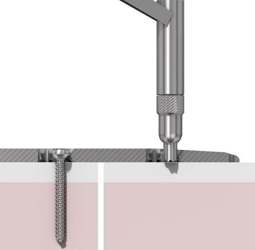 Tecnica di compressione Per perforare un foro per la compressione dinamica, posizionare il centrapunte universale sul bordo della porzione non filettata del foro combinato, senza esercitare