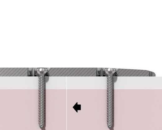 Il serraggio della vite da corticale produrrà una compressione dinamica (2). 1 2 Nota: se e quando eseguire una compressione dipende dal tipo di frattura e dalla tecnica di riduzione.