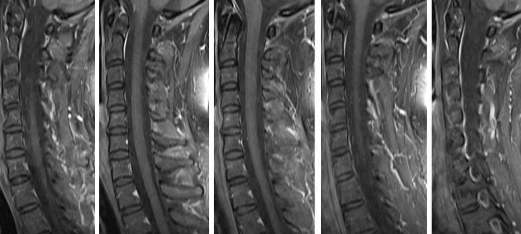 RM CERVICALE Impregnazione diffusa con