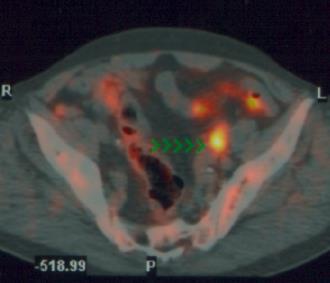 Updated June 2013 Our experience: diagnostic workup Endocoil MRI Fluorocholine PET-CT Both HR PCa 43 (55%) 12 (16%) 8 (10%) VHR PCa 14 (73%) 14 (73%) 9