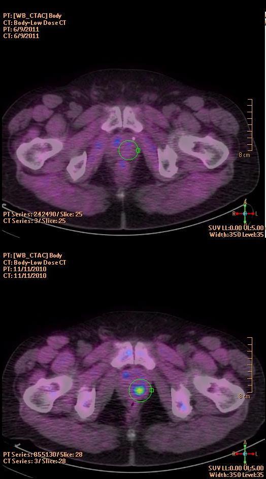 intraprostatic lesions and of extracapsular extension.