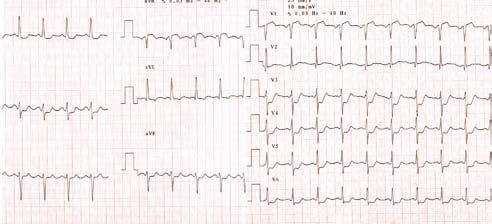 diminuite, mentre quelle di NSTEMI sono più che raddoppiate [3].