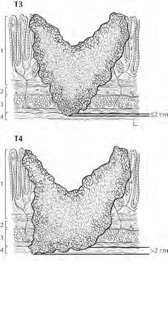 Avventizia 1. Mucosa 2. Sottomucosa 3. Muscolare propria 4. Tessuto perimuscolare (mesentere, avventizia retroperitoneale o sottosierosa) FIGURA 11.5.