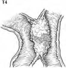 mentre si definisce T4 una neoplasia che invade direttamente altri organi o strutture (inclusi mesentere e retroperitoneo) per più di cm 2.