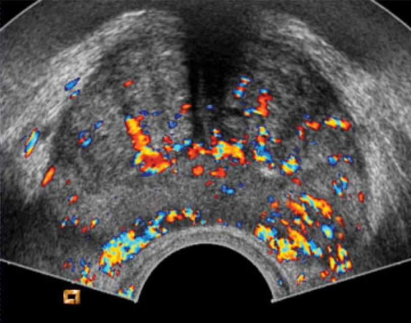 Contrast enhanced US Tecnica descritta per la prima volta nel 1968 Sfrutta «microbolle» iniettate per via endovenosa e rimangono all'interno dei vasi sanguigni, compresi i microvasi Diametro