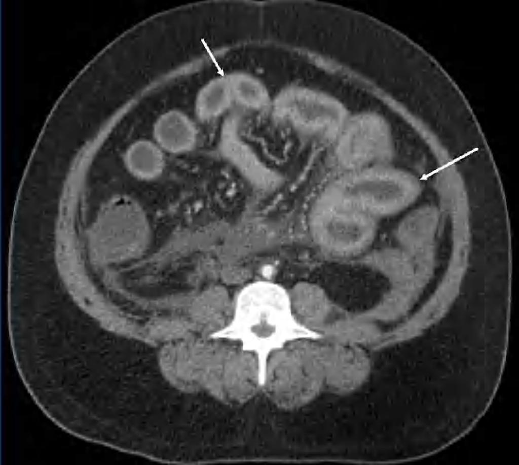 TC Segni Indiretti Round Belly Sign (RBS) Bowel Wall Thickenin