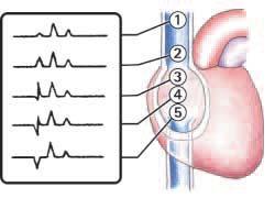 4. Sistema dei detector METODO ECG-GUIDATO 1. VCS, 1/3 sup. 2. VCS, 1/3 inf 3.