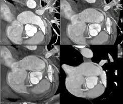 Esami strumentali diagnostici di cardiopatie Angio TAC Permette, con l uso di mezzo di contrasto, lo studio 3-D delle strutture vascolari Indicazioni malattia del parenchima