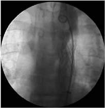 aortiche polmonari Aumento delle procedure ibride che vedono impegnati emodinamisti e cardiochirurghi Uniche indicazioni a