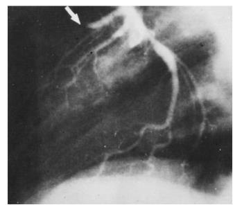 Stimolazione della Fibrinolisi nel trattamento dell infarto del