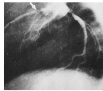 tpa ricombinante Streptokinasi Urokinasi Dopo infusione di TPA