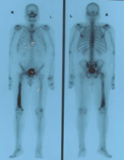 Caso Clinico mcrpc Settembre 2016 TERMINA RADIO 223 6 cicli PSA 15 ng/dl Testosterone <0.