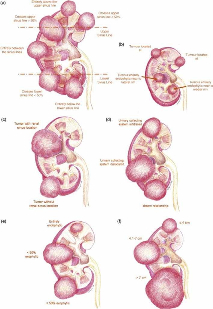 Longitudinal (polar) location Superior/inferior Middle 1 2 Exophytic rate 50% <50% Endophytic 1 2 3 Renal rim Lateral Medial 1 2 Renal