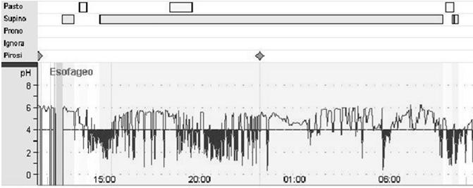 CASO CLINICO # 2 Esofagite di grado moderato AU4 = 154,20 phxmin Ph-Impedenzometria (MII-ph) Registra