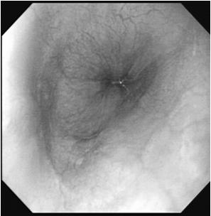 del bolo esofageo indipendentemente dal suo Ph Alcuni studi sembrano confermare che la Phmetria da sola