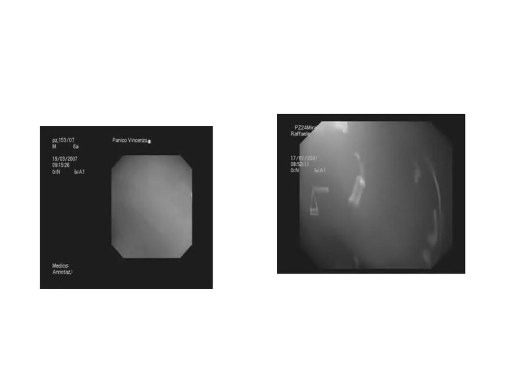 ENDOSCOPIA DIGESTIVA VANTAGGI SVANTAGGI - applicabile a qualsiasi età - solo in Centri specialistici - non radiazioni - esame invasivo - valutazione