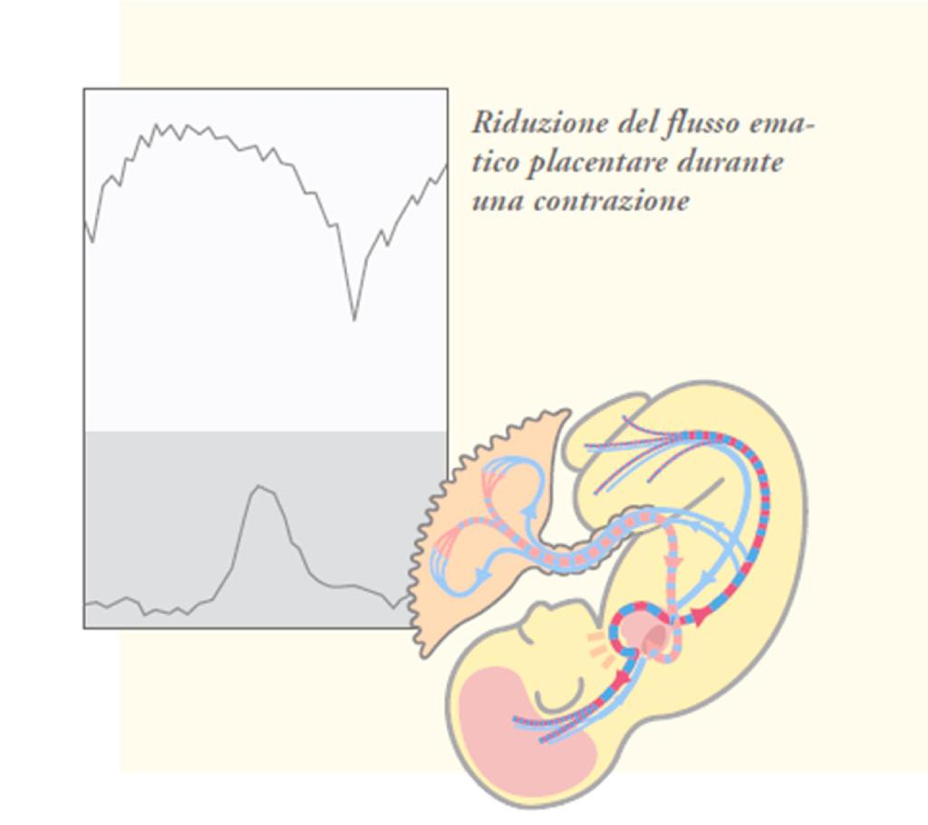 The oxigen and CO2 exchange from fetus to mother is interrupted during a contractions (when the uterine pressure