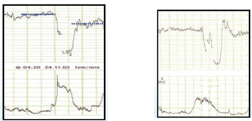 analysis of tracing